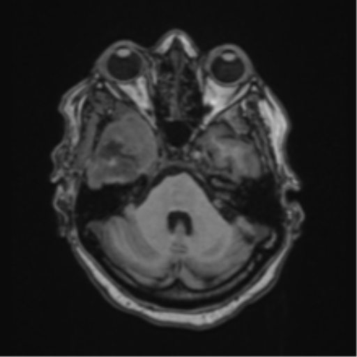 Atypical meningioma (WHO Grade II) (Radiopaedia 54742-60981 Axial T1 18).png