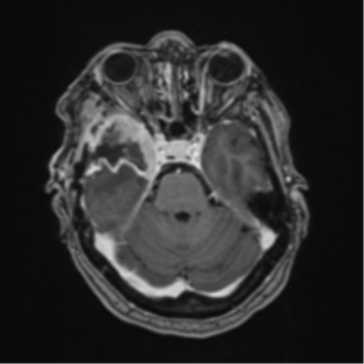 Atypical meningioma (WHO Grade II) (Radiopaedia 54742-60981 Axial T1 C+ 21).png
