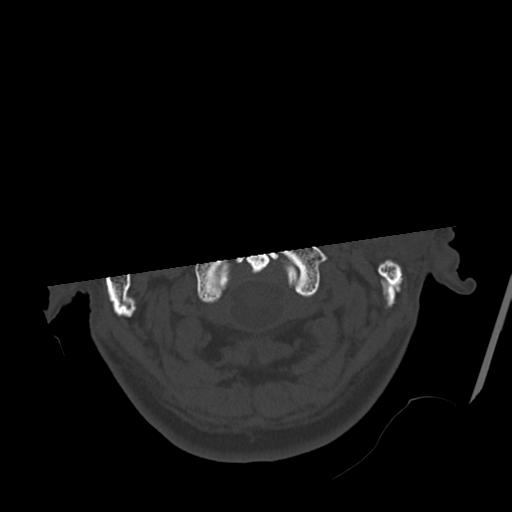 Atypical meningioma (WHO grade II) with osseous invasion (Radiopaedia 53654-59715 Axial bone window 6).png