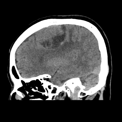 Atypical meningioma (WHO grade II) with osseous invasion (Radiopaedia 53654-59715 C 18).png