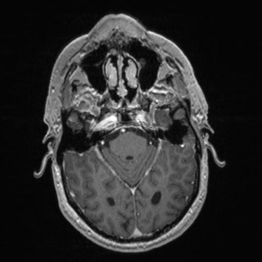 Atypical meningioma (grade II) - en plaque (Radiopaedia 29633-30147 Axial T1 C+ 63).jpg