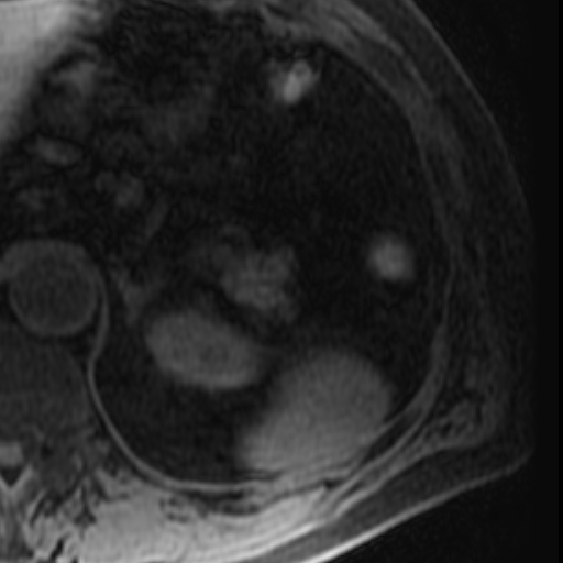 File:Atypical renal cyst on MRI (Radiopaedia 17349-17046 Axial T1 fat sat 4).jpg