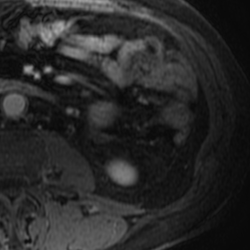 File:Atypical renal cyst on MRI (Radiopaedia 17349-17046 D 30).jpg