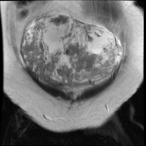 File:Atypical retroperitoneal lymphocoeles with large leiomyoma of uterus (Radiopaedia 32084-33027 Coronal T2 5).jpg