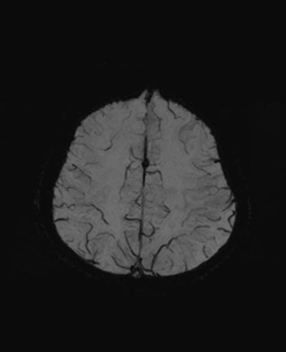Autoimmune limbic encephalitis (Radiopaedia 30363-31005 SWI - mIP 56).jpg