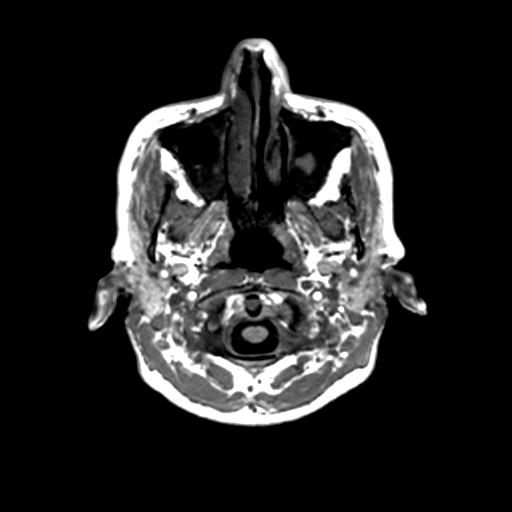 Autoimmune limbic encephalitis (Radiopaedia 30363-31005 T1 Axial 1mm 10).jpg