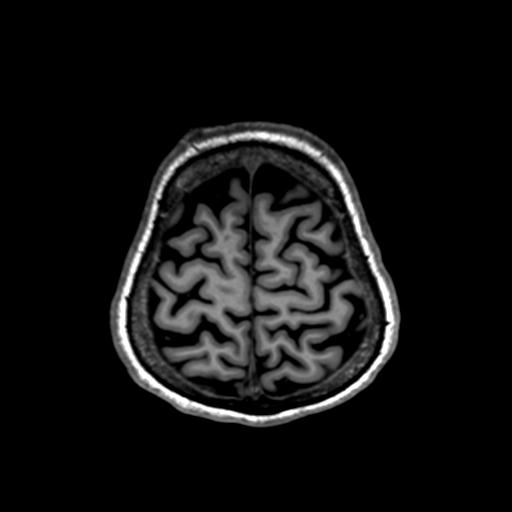 Autoimmune limbic encephalitis (Radiopaedia 30363-31005 T1 Axial 1mm 129).jpg