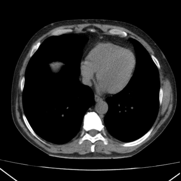 File:Autosomal dominant polycystic kidney disease (Radiopaedia 36539-38101 Axial non-contrast 3).jpg