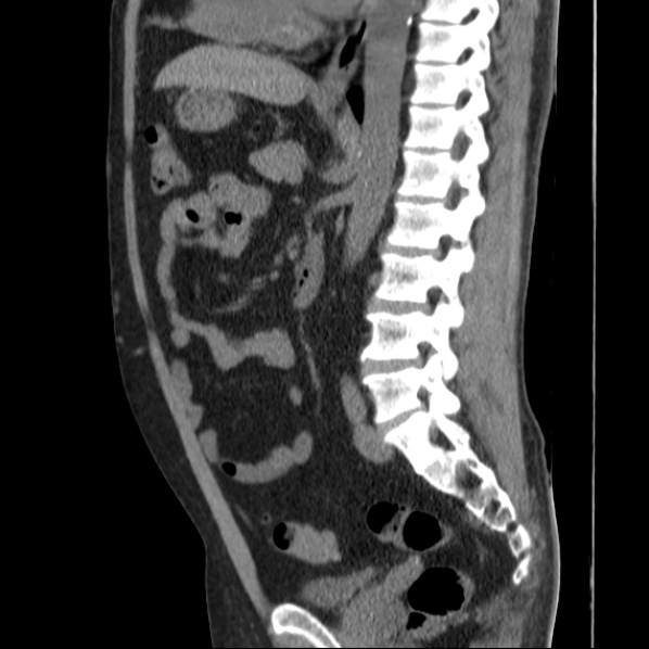 File:Autosomal dominant polycystic kidney disease (Radiopaedia 36539-38101 D 47).jpg