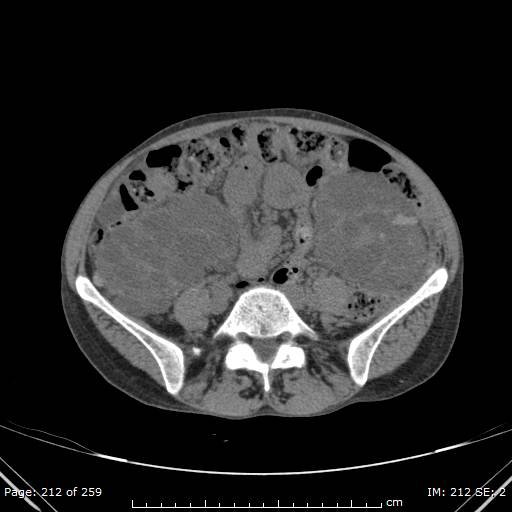 File:Autosomal dominant polycystic kidney disease (Radiopaedia 44122-47684 Axial 58).jpg