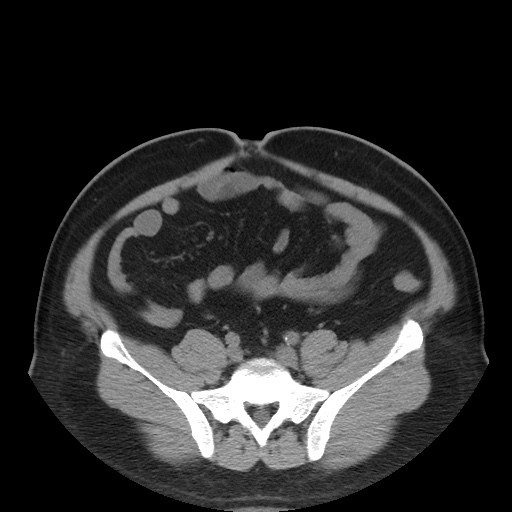 Autosomal dominant polycystic kidney disease (Radiopaedia 50259-55612 Axial non-contrast 62).jpg
