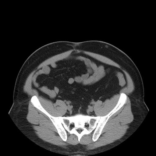 Autosomal dominant polycystic kidney disease (Radiopaedia 50259-55612 Axial non-contrast 65).jpg