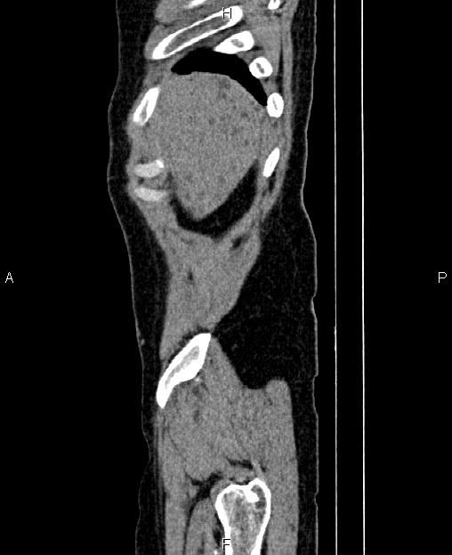 Autosomal dominant polycystic kidney disease (Radiopaedia 87830-104287 C 3).jpg