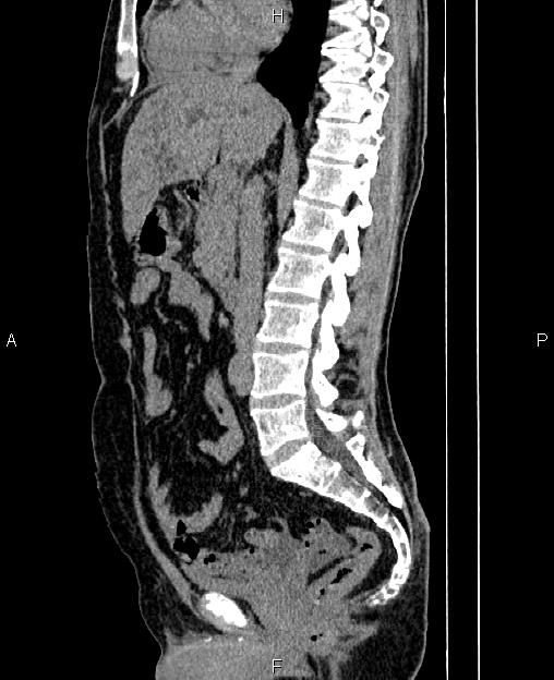 Autosomal dominant polycystic kidney disease (Radiopaedia 87830-104287 C 43).jpg