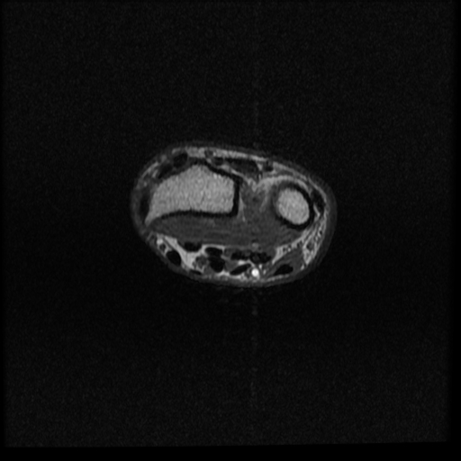 File:Avascular necrosis - scaphoid non-union (Radiopaedia 63457-72065 Axial T1 20).jpg