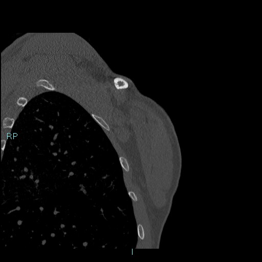 Avascular necrosis after fracture dislocations of the proximal humerus (Radiopaedia 88078-104655 Coronal bone window 129).jpg