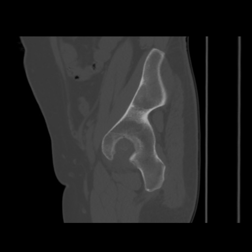 File:Avascular necrosis of the hip (Radiopaedia 61503-69467 B 43).jpg