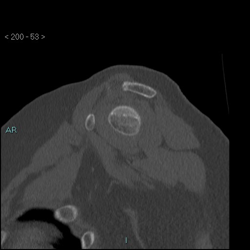 Avascular necrosis of the shoulder - Cruess stage I (Radiopaedia 77674-89887 Sagittal bone window 52).jpg