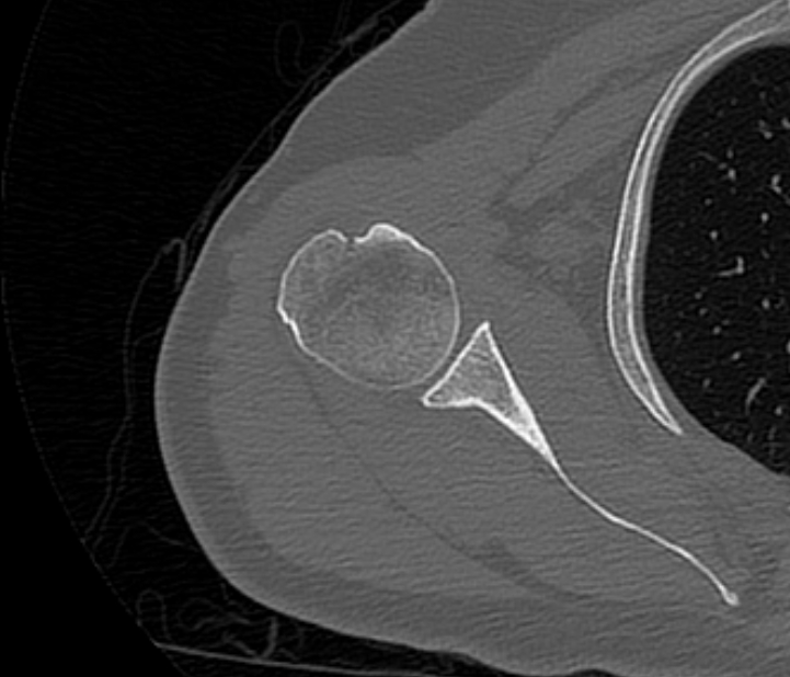 Avulsion fracture - greater tuberosity of humerus (Radiopaedia 71216-81514 Axial bone window 41).jpg