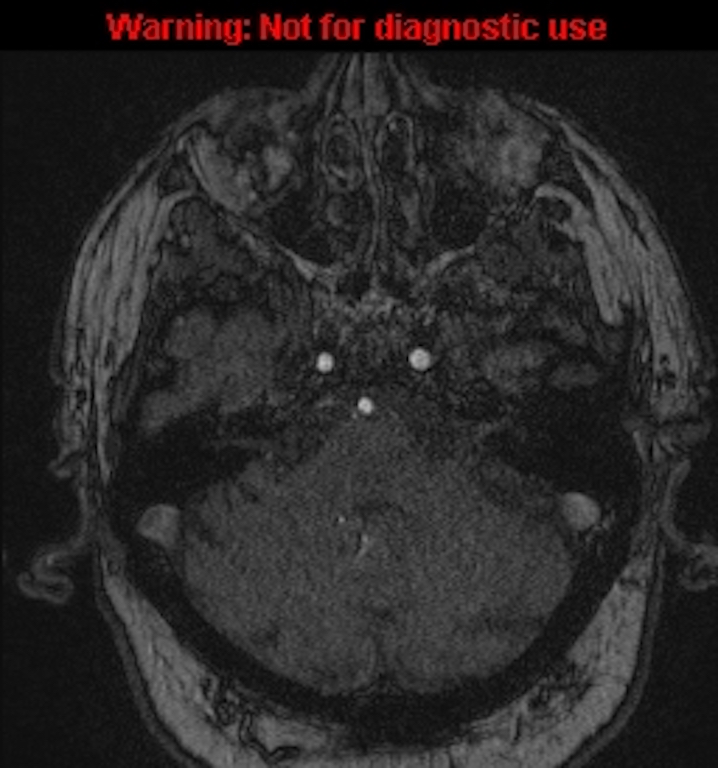 Azygos anterior cerebral artery (Radiopaedia 59325-66677 Axial MRA 34).jpg