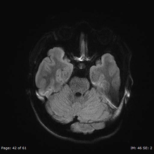 Balo concentric sclerosis (Radiopaedia 61637-69636 Axial DWI 42).jpg