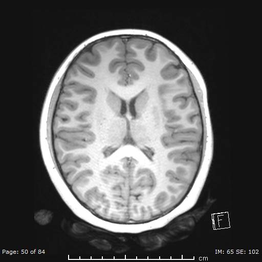 Balo concentric sclerosis (Radiopaedia 61637-69636 Axial T1 50).jpg