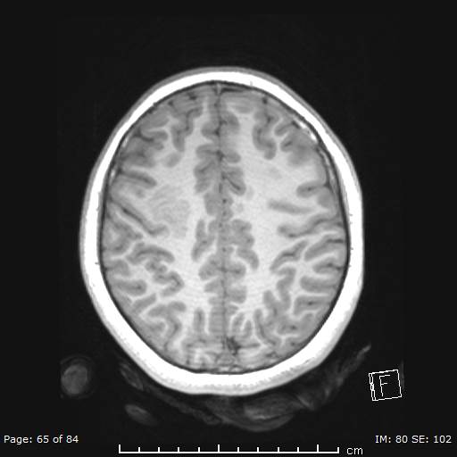 File:Balo concentric sclerosis (Radiopaedia 61637-69636 Axial T1 65).jpg