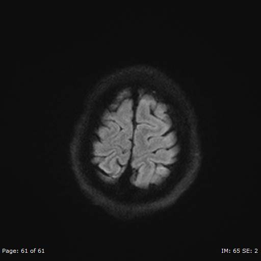 Balo concentric sclerosis (Radiopaedia 61637-69636 I 374).jpg