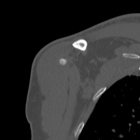 Bankart lesion (Radiopaedia 57256-64185 Coronal bone window 7).jpg