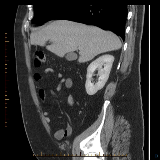File:Bariatric balloon causing gastric outlet obstruction (Radiopaedia 54449-60672 C 59).jpg