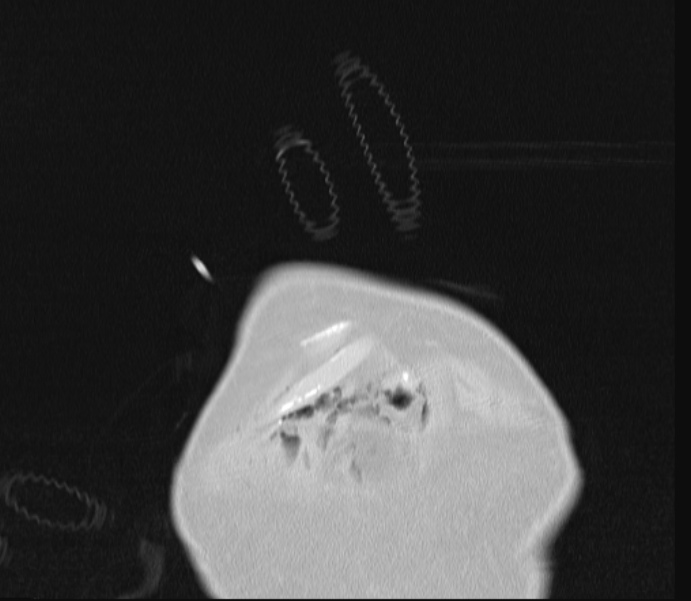 Barotrauma due to mechanical ventilation (Radiopaedia 28079-28336 Coronal lung window 4).jpg