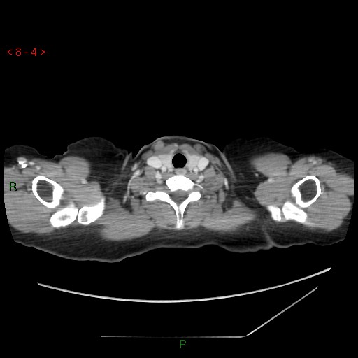 Bartholin gland cyst (Radiopaedia 54904-61181 A 1).jpg