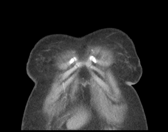 Basal ganglia metastasis (Radiopaedia 78928-91832 C 7).png