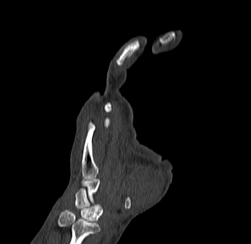 Base of 2nd metacarpal fracture (Radiopaedia 73741-84544 Coronal bone window 34).jpg