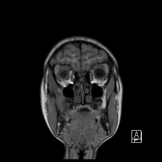 Base of skull rhabdomyosarcoma (Radiopaedia 32196-33142 Coronal T1 4).jpg