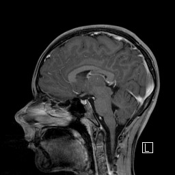 Base of skull rhabdomyosarcoma (Radiopaedia 32196-33142 J 34).jpg