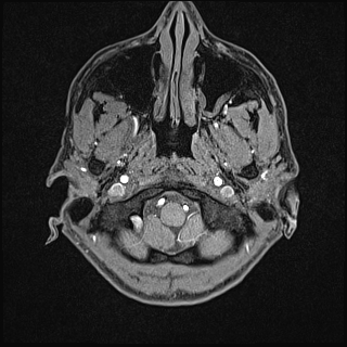 Basilar artery perforator aneurysm (Radiopaedia 82455-97733 Axial T1 fat sat 8).jpg