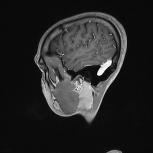 File:Basilar artery perforator aneurysm (Radiopaedia 82455-97733 G 25).jpg