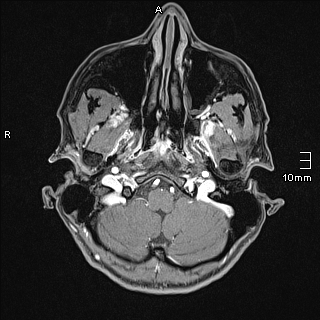 Basilar artery perforator aneurysm (Radiopaedia 82455-99523 G 7).jpg