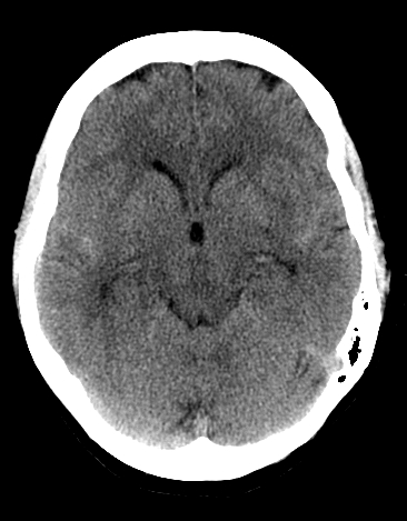 File:Basilar tip aneurysm with coiling (Radiopaedia 53912-60033 Axial 9).jpg