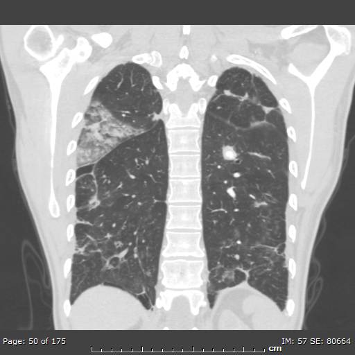 File:Behçet disease (Radiopaedia 44247-47889 Coronal lung window 12).jpg