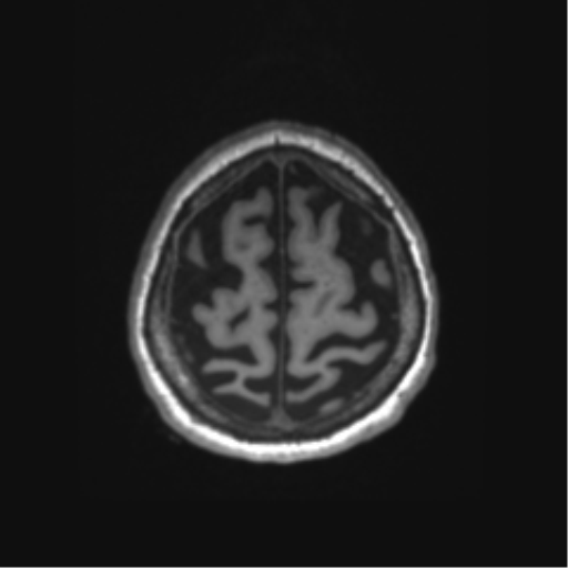 Behavioral variant frontotemporal dementia and late onset schizophrenia (Radiopaedia 52197-58083 Axial T1 3).png