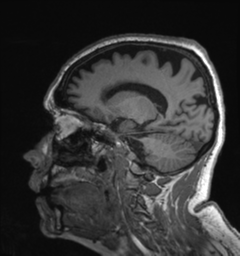 Behavioral variant frontotemporal dementia and late onset schizophrenia (Radiopaedia 52197-58083 Sagittal T1 32).png