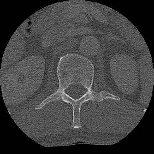 Benign post-traumatic pseudopneumoperitoneum (Radiopaedia 71199-81495 Axial bone window 183).jpg
