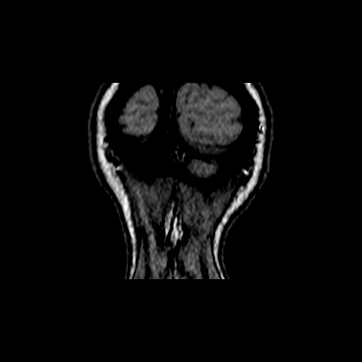 Berry aneurysm of the terminal internal carotid artery (Radiopaedia 88286-104918 Coronal TOF 120).jpg