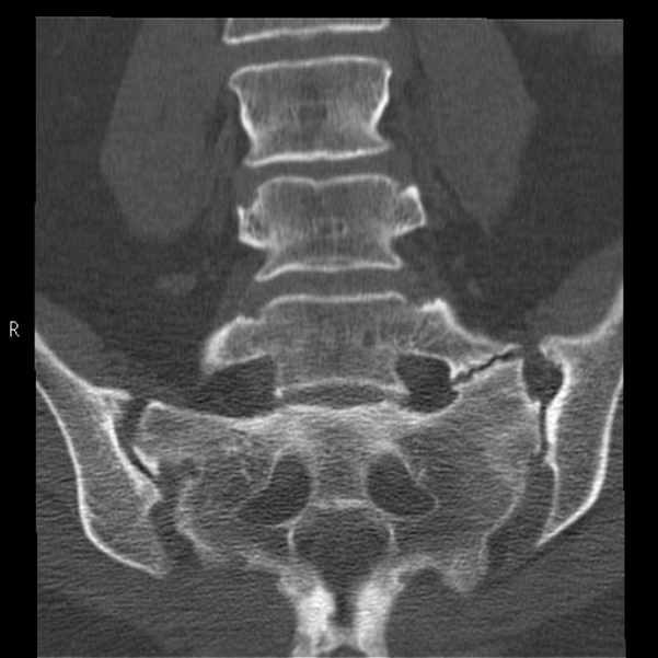 Bertolotti syndrome (Radiopaedia 24864-25128 Coronal bone window 26).jpg