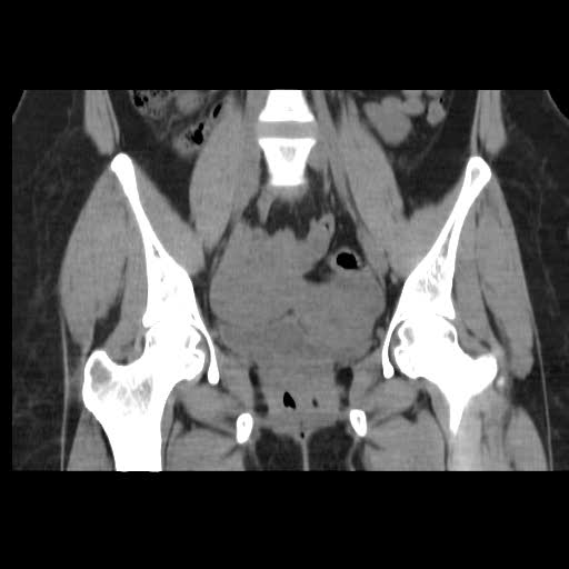 File:Bicornuate uterus- on MRI (Radiopaedia 49206-54296 Coronal non-contrast 10).jpg