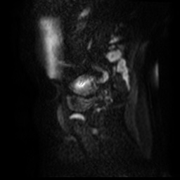 File:Bicornuate uterus (Radiopaedia 51676-57472 Sagittal DWI 34).jpg