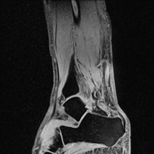 Bilateral Achilles tendon complete tear (Radiopaedia 81344-95051 Sagittal WE - Right 37).jpg