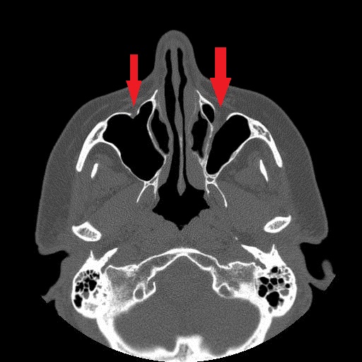 File:Bilateral Ectopic Infraorbital Nerves (Radiopaedia 49006-58325 Axial 3).jpg